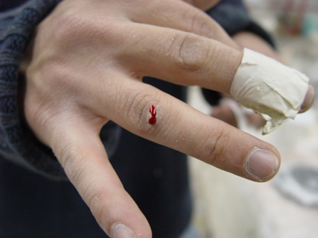 right hand with small cut in finger